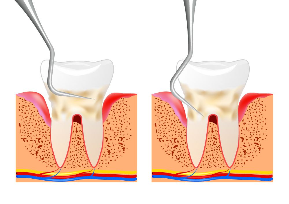 Illustrations highlighting plaque and tartar