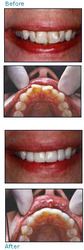 Before and after dental patient pictures