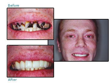 Before and after dental patient pictures