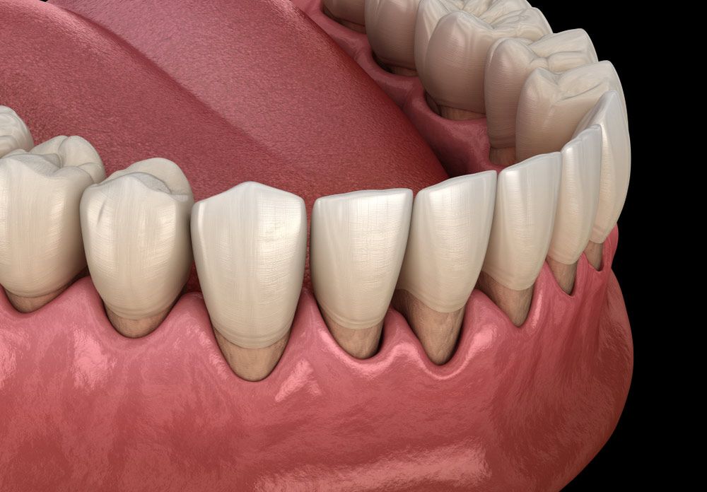 Illustration of recessed gums