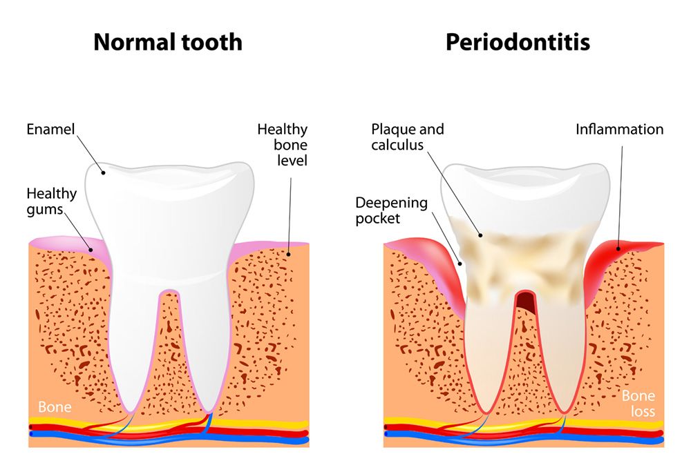 Graphic of a tooth with gum disease and one without